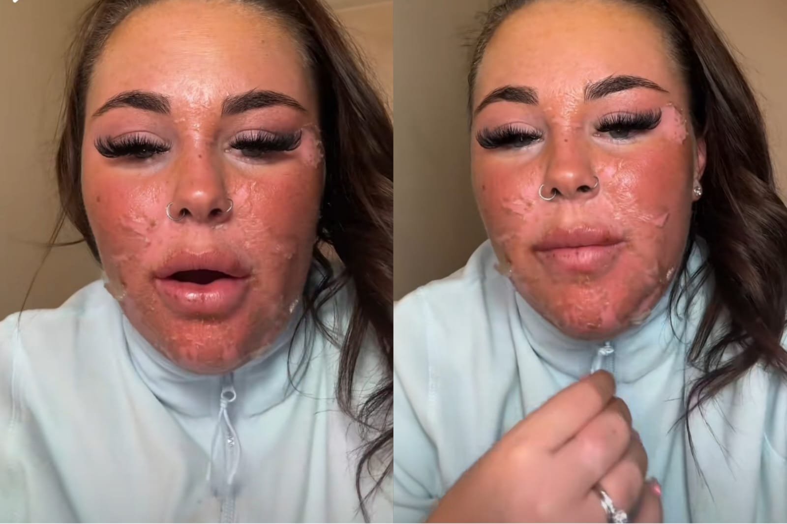Mulher é hospitalizada após erro com bronzeamento artificial