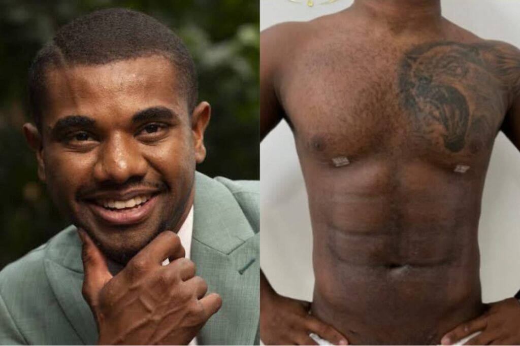 Davi Brito leva hate ao mostrar antes e depois de Lipo HD