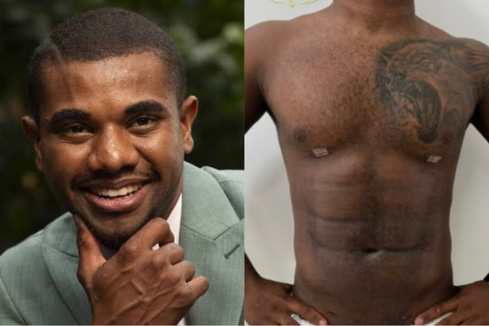 Davi Brito leva hate ao mostrar antes e depois de Lipo HD
