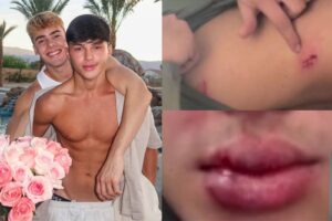 Luan Alencar aparece com o rosto desfigurado após agressão de Caio Cerqueira